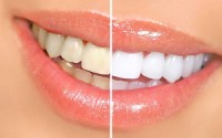 چگونه دندان سفید و براق داشته باشیم؟